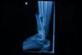 Human x-rays showing fracture of right leg