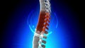 Hurt Backbone X-Ray - Vertebrae Pain