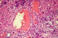 Hyaline degeneration of renal artery