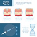 Hyaluronic acid filler injection infographic Royalty Free Stock Photo