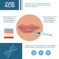 Hyaluronic acid filler injection infographic Royalty Free Stock Photo