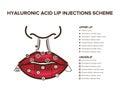 Hyaluronic acid filler. Lip injections. Lip anatomy