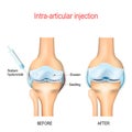 Hyaluronic acid injection for knee osteoarthritis