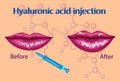 Hyaluronic acid injection,lips procedure vector illustration,