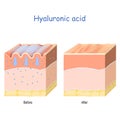 Hyaluronic acid. skin-care products