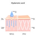 Hyaluronic acid. skin Royalty Free Stock Photo