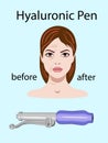 Hyaluronic pens on the light background isolated, vector illustration