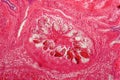 Hydatid cyst of liver caused by tapeworm parasite Echinococcus granulosus
