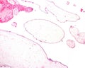 Hydatidiform mole Royalty Free Stock Photo