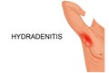 Hydradenitis. inflammation of the sweat glands.