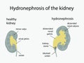 Hydronephrosis and healthy kidneys. Urology. Diagnosis of kidney disease.