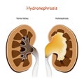 Hydronephrosis. Normal kidney and kidney with disorders Royalty Free Stock Photo