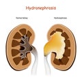 Hydronephrosis. Normal kidney and kidney with disorders