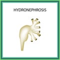 Hydronephrosis. Pelvis. Kidney. Infographics. Vector illustration on isolated background