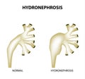 Hydronephrosis. Pelvis. Kidney. Infographics. Vector illustration on isolated background