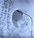 Hydronephrosis pyelostomy tube ureter obstruction