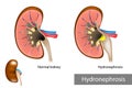 Hydronephrosis. Urinary Tract Dilation