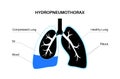 Hydropneumothorax medical poster