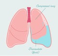 Hydrothorax in human lung. Gathering of fluid in pleural space - vector anatomical scheme