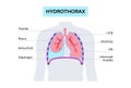 Hydrothorax medical poster