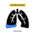 Hydrothorax medical poster