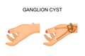 Hygroma wrist joint