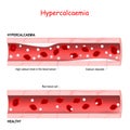 Hypercalcaemia. hypercalcemia is a high calcium level in the blood