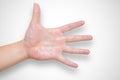 Hyperhidrosis syndrome hand sweat