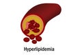 Hyperlipidemia with blood vessel isolated Royalty Free Stock Photo