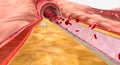 In hyperlipidemia, excess lipids can build up on artery walls an