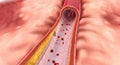 In hyperlipidemia, excess lipids can build up on artery walls an