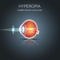 Hyperopia corrected