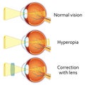 Hyperopia corrected by a plus lens.