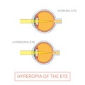 Hyperopia of the eye