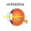 Hyperopia eyesight disorder.