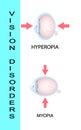 Hyperopia and Hyperopia corrected by a plus lens. Eye vision disorder.