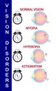 Hyperopia and Hyperopia corrected by a plus lens. Eye vision disorder