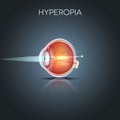 Hyperopia, long sighted eye