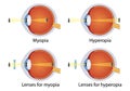 Hyperopia and myopia corrected by lens. Concept of eyes defect. Correction of various eye vision disorders by lens