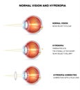 Hyperopia and normal vision