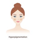 Hyperpigmentation and dark spots on woman face vector isolated on white background.