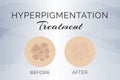 Hyperpigmentation Treatment Before and After Illustration Design Royalty Free Stock Photo