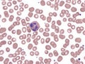 Hypersegmented eosinophil in peripheral blood (Natalizumab). Royalty Free Stock Photo