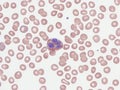 Hypersegmented eosinophil in peripheral blood (Natalizumab). Royalty Free Stock Photo