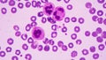 Hypersegmented neutrophil is a clinical seen . It is drawing blood from a patient and view the blood smear under a
