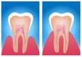 Hypersensitive teeth and normal teeth Royalty Free Stock Photo