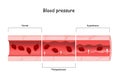 Hypertension. high blood pressure. Cross section of blood vessel with red blood cells