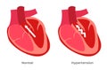 Hypertension , high blood pressure / human anatomy