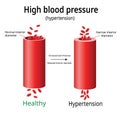 Hypertension, high blood pressure vector,