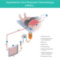 Hyperthermic Intra Peritoneal Chemotherapy. The use of chemotherapy to destroy intestine cancer cells through fluid in the abdomen